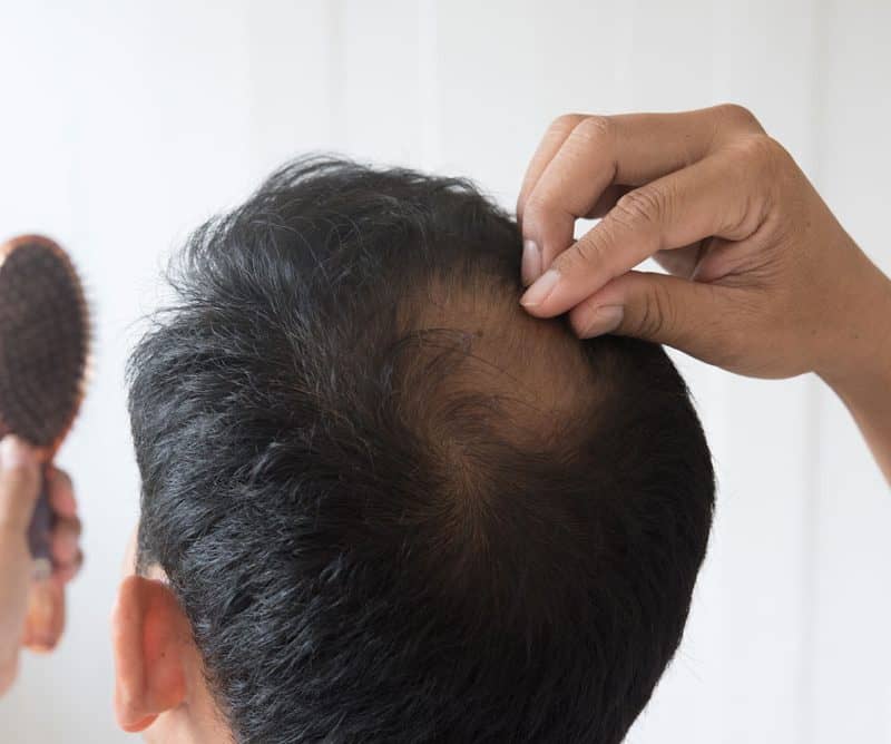 chronic hair loss