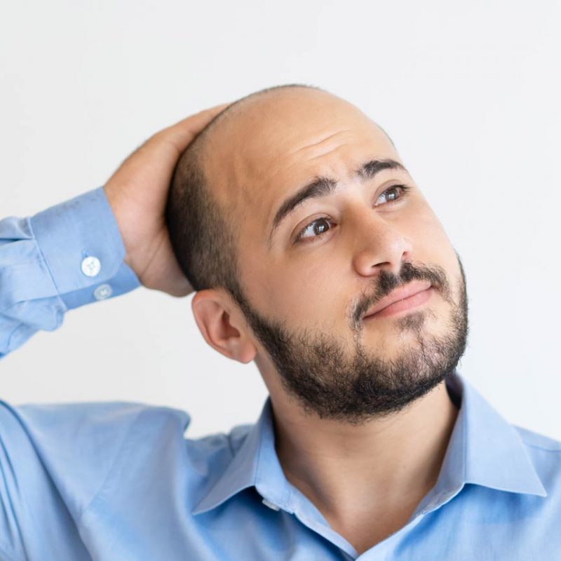 male pattern baldness