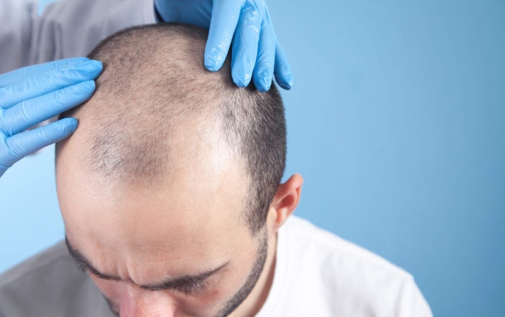 hair transplant