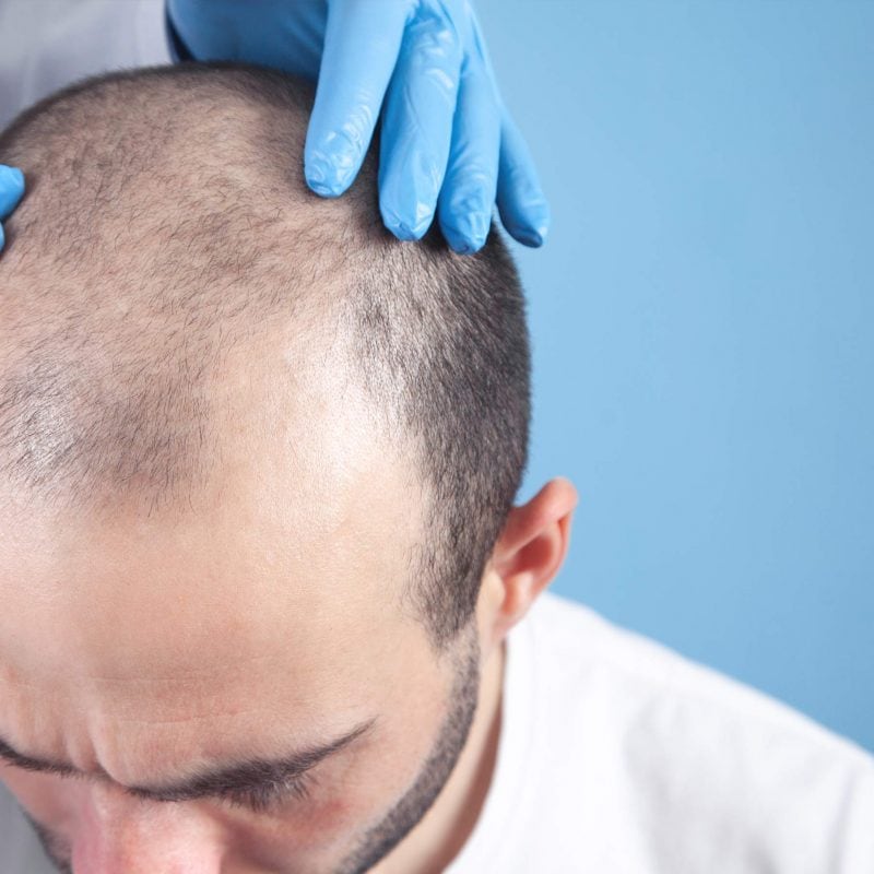 hair transplant